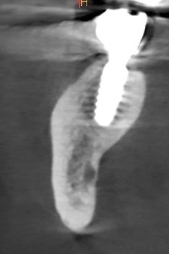 Implantes
