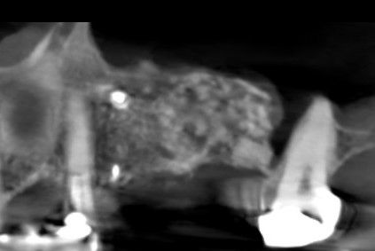 Regeneración ósea 6